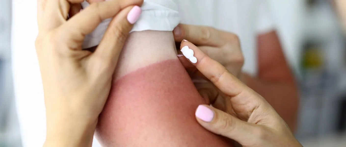 Sunburn Teruk