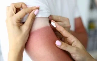 Sunburn Teruk