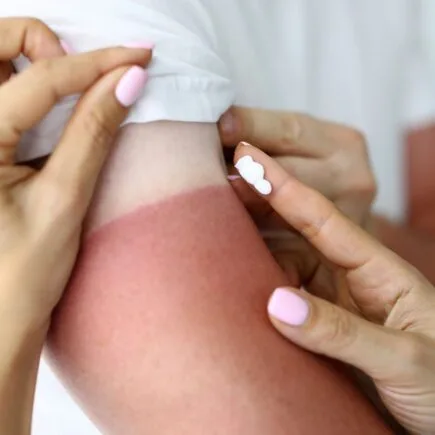 Sunburn Teruk