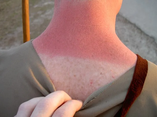 Sunburn Teruk